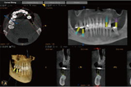 見えない顎の骨のズレなどを確認する高精密3D CT