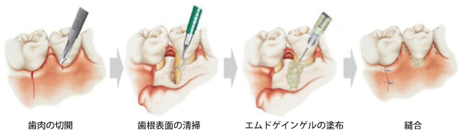 エムドゲインゲル手順