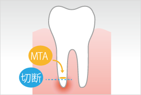 根管切除術