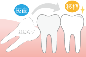 歯の移植・再植術