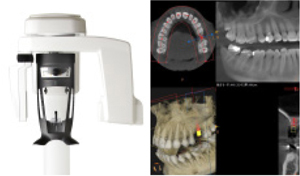 より正確な診査・診断が可能になる3D 歯科用CT
